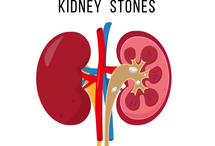 Kidney stone disease. Human kidneys anatomy inside and outside. Internal organ icon isolated on white background. Medical concept of diseased urinary system. Vector illustration.